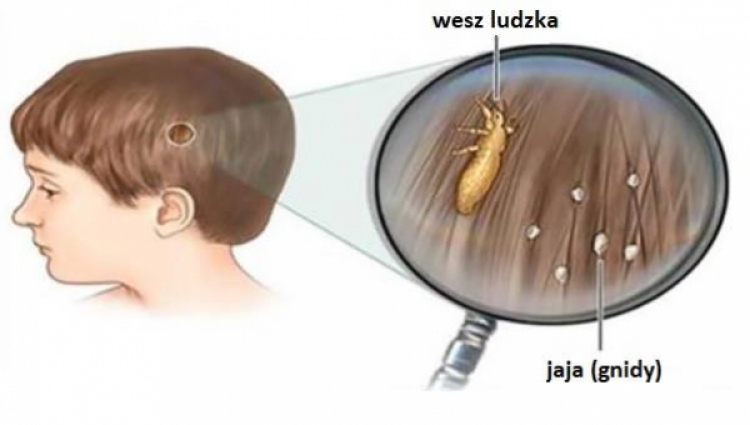 Farmaceutické firmy nechtějí, abychom věděli o této domácí metodě proti vším, nikdo na tom poté už nevydělá...